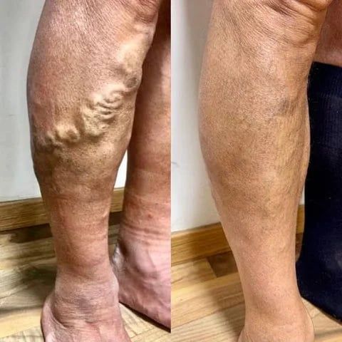 Spider & Varicose Vein Relief Patches™